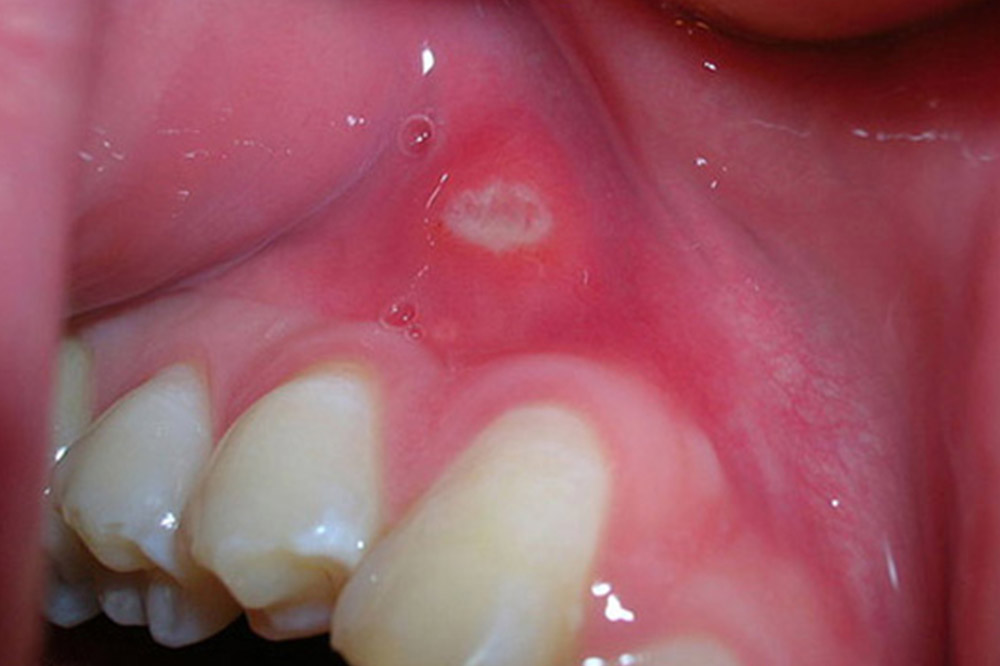 Read more about the article Uloga doktora dentalne medicine u ranom otkrivanju zločudnih bolesti u usnoj šupljini