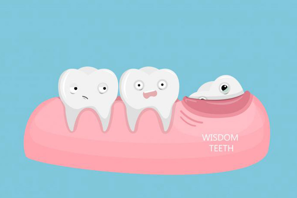Read more about the article Što je to impaktirani zub?